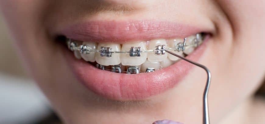 Implants dentaires quand vous voulez un sourire sain post thumbnail image