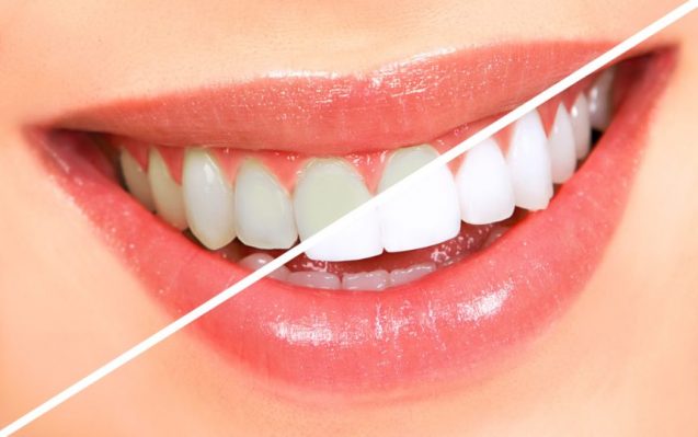 Les différents types de procédures de blanchiment des dents post thumbnail image