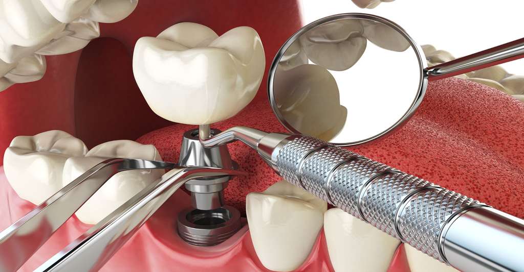 Implant dentaire – La meilleure cicatrisation et le meilleur délai de récupération post thumbnail image