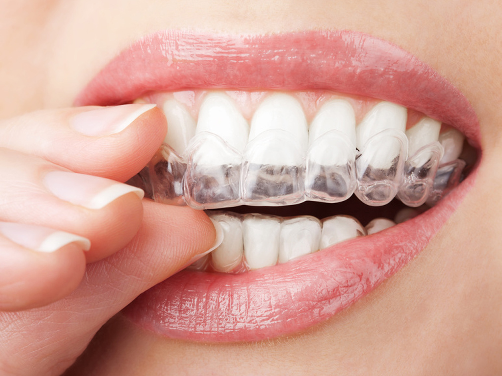 Le blanchiment des dents provoque-t-il une sensibilité dentaire ? post thumbnail image